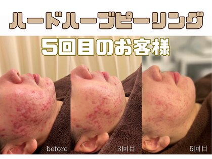 美肌ケアサロンiru 千葉店【ハーブピーリング | ララピール | 毛穴洗浄】の写真