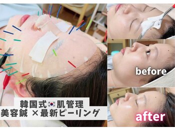 ホジュン鍼灸整体院の写真/「肌もキレイにしたい」「フェイスラインもスッキリさせたい」セラピール×美容鍼で韓国式トータル美容
