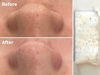 ファシー 四日市(fachi.)/シート・クリームで徹底ケア