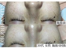 サロン ヒゴロ(SALON HIGORO)/シミケア