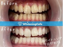 ホワイトニングカフェ 豊中店(WhiteningCafe)/◎歯のホワイトニング施術写真◎