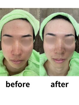 ルポ(Repos)/メンズエステシェービング