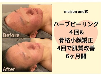 メゾンワン(maison one)/ハーブ×小顔矯正の組み合わせ♪