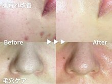 エーアール(ar)の雰囲気（ニキビケア/ハリツヤくすみ肌質改善ハーブピーリング×毛穴ケア）