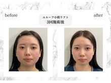 トキ(TOKI)/ユルーフ小顔リフト　3回施術後