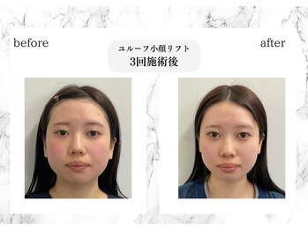 トキ(TOKI)/ユルーフ小顔リフト　3回施術後