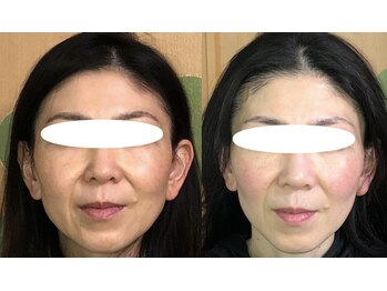 ふくふく/小顔矯正