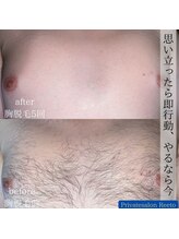 リエート(Reeto)/メンズ脱毛