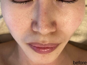 サロン ド エメ(salon de aimer)/【Before】毛穴や赤みに♪