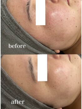 ベール(BEHL)/ジェリーマスクのBefore After