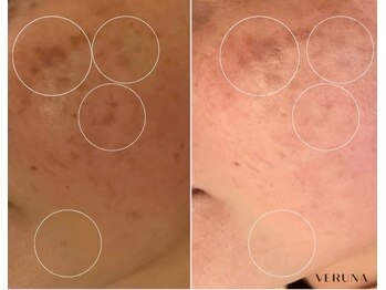 ボニータアンジュ 恵比寿(Bonita Ange)/恵比寿ハーブピーリング｜症例