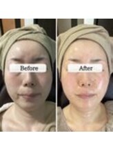 ル ボヌール 伊那店(le bonheur)/シミ改善コース月2来店半年経過