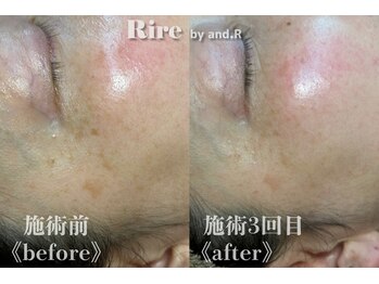 リル バイ アンドアール(Rire by and.R)/シミケア（施術3回）