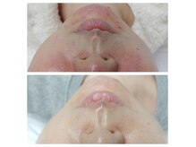 ウェリナベル(WelinaBelle)の雰囲気（韓国美容で注目のララピール毛穴・ニキビケア・シミシワケア）