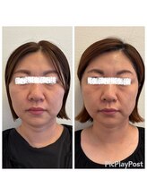 ケアラボ(Care Labo)/【谷口FN美容鍼】