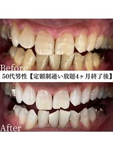 ホワイト 福岡天神店(WHITE)/ホワイトニングビフォーアフター