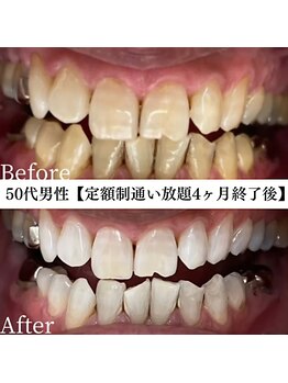 ホワイト 福岡天神店(WHITE)/ホワイトニングビフォーアフター