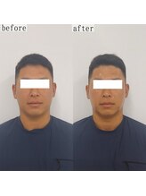 ヴェルシック(Belchic)/男性からも人気の韓国造顔リフト