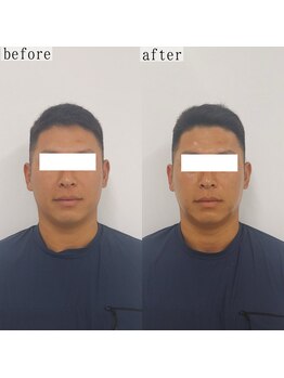 ヴェルシック(Belchic)/男性からも人気の韓国造顔リフト