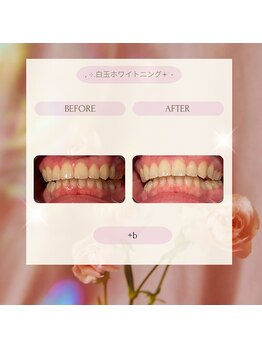 プラスビーセルフ(+b self)/ホワイトニングビフォーアフター
