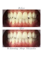 ホワイトニングショップ 静岡店/ホワイトニングBefore→After