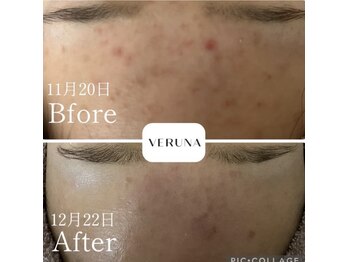 リリベル(LilyBell)/Before After