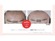 トリアングル(TLIENGLE)/最新ポレーションビフォアフ