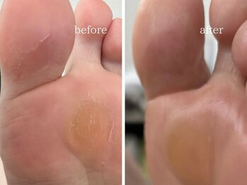 爪のいろは/フットケア　足裏　角質ケア