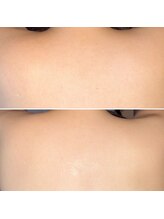 ディスタンビューティー(Destin Beauty)/背中まつやにでちゅ～るん