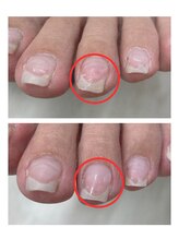 ふっとけ庵/爪の亀裂止め