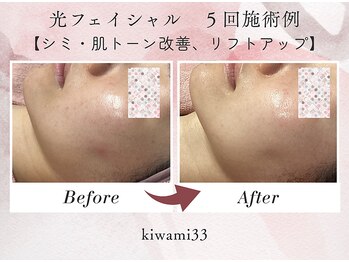 キワミ サーティスリー(kiwami33)/光フェイシャル施術例