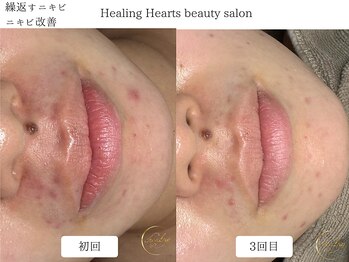ヒーリングハーツ(Healing Hearts)/3回目!肌質改善/ニキビケア