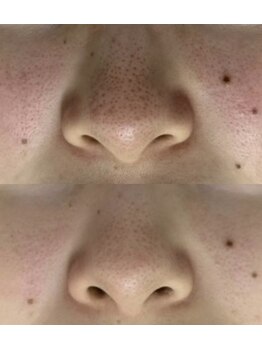 オレオマ(OLEOMA)の写真/デパコス使っても変わらなった毛穴ここまで変わる。
