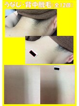 スターポルト(Star-Porte)/襟足＋背中上脱毛