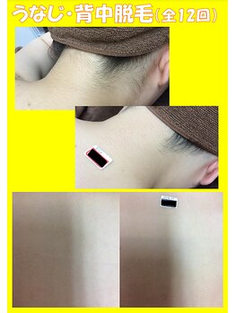 スターポルト(Star-Porte)/襟足＋背中上脱毛