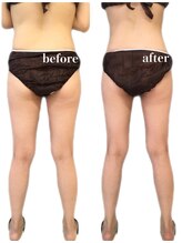 リリィブラン(Lily branc)/痩身/サイズダウン/ダイエット