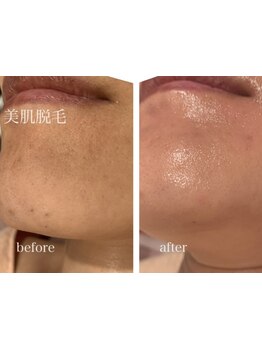 顔脱毛がしたい