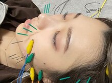 ソウノ 御茶ノ水(Souno)/美容鍼