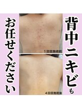 トゥモロー(TOMORROW) 人気No.2 背中ニキビ