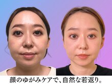 ナチュラルビューティーフェイス 横浜(NBF)/Before&After