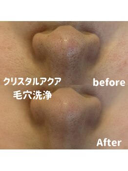 ブルームーン(BLUE MOON)/毛穴洗浄