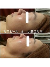 ロージースマイル(Rosy smile)/【韓国肌管理★　セラピール　】