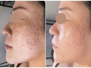 ローリエの写真/肌が変わる!?毛穴・くすみ・肌荒れケアの救世主！プラズマフェイシャル×肌質改善×本格美肌ケアが大好評！