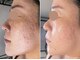 ローリエの写真/肌が変わる!?毛穴・くすみ・肌荒れケアの救世主！プラズマフェイシャル×肌質改善×本格美肌ケアが大好評！
