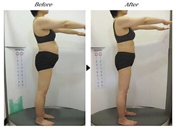 ビューティークリニックコダマ 日南店/【1か月コース】F.N様（45歳）