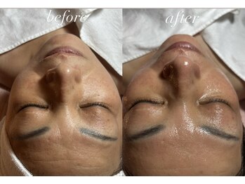 スパークル/フェイシャル/たるみ/シワ改善