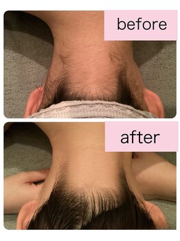 ゲッカ(GEKKA)/うなじ襟足脱毛