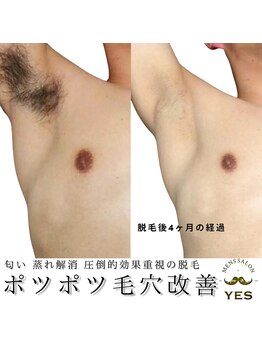イエス 東京池袋店(YES)/脇脱毛