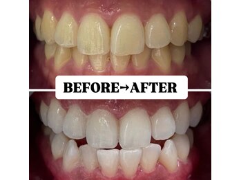 ホワイトニングサロン 豊中/Before&After美白ホワイトニング