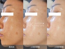 レディラックビューティー 横浜(Lady Luck beauty)/美白ケア、シミにもおすすめ★